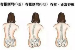 孩子脊椎變形的原因您知道多少？